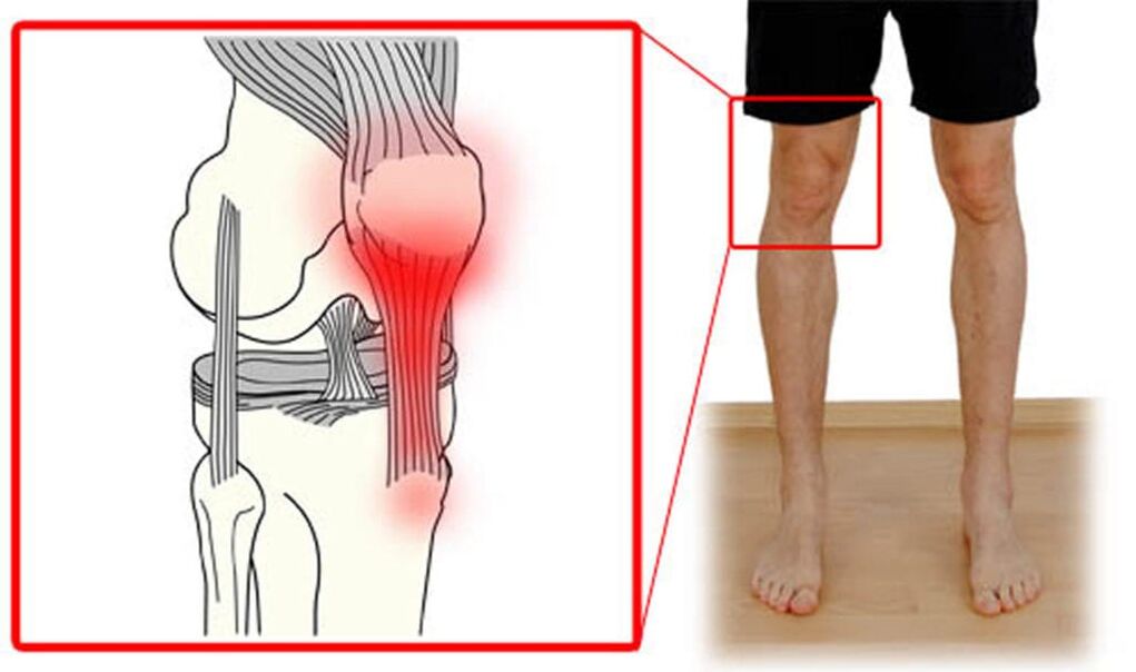 Tendonitis – vnetje kite v kolenskem sklepu