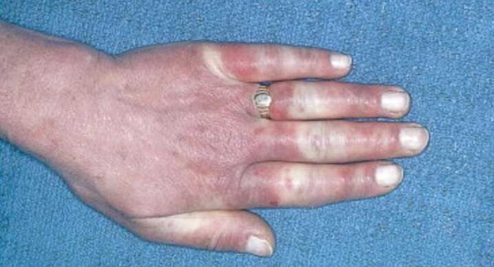 Klinična slika Raynaudovega sindroma - vazospazem, hiperemija, edem