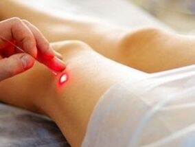 Zdravljenje artroze kolenskega sklepa z laserjem